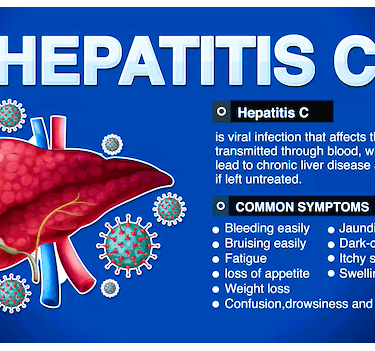 hepatitis c