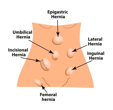 Hernia