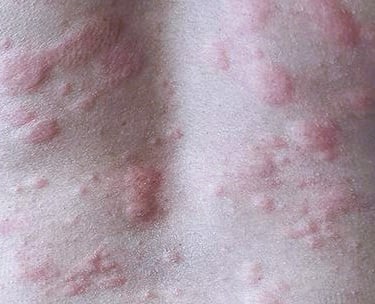 Hives
