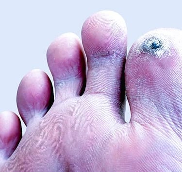 hyperkeratosis