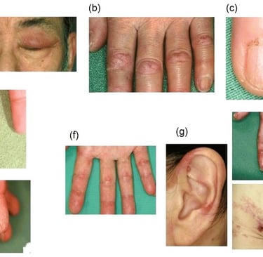 lung disease
