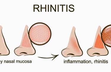 rhinitis
