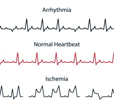 Irregular Heartbeats