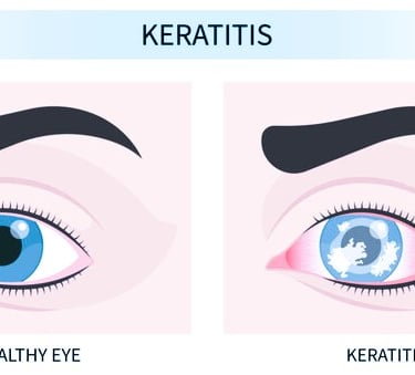 keratitis