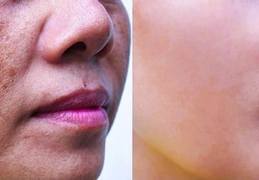 melasma
