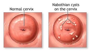 nabothian cysts