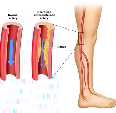 Peripheral Vascular Disease