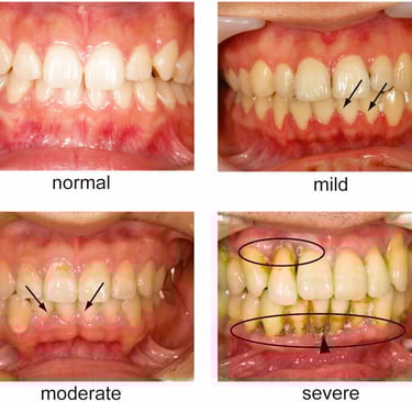 Periodontal disease