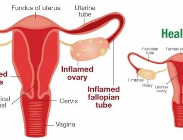 Pelvic Inflammatory Disease (PID)