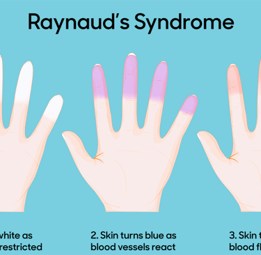ray-syndrome