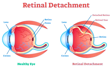 retina