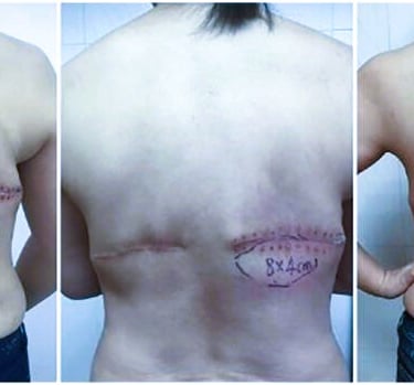 seroma