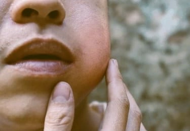 mumps