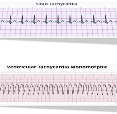 tachycardia