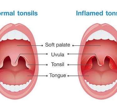 tonsils