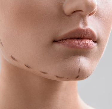 Close-up of a chin with surgical markings for a cosmetic procedure.