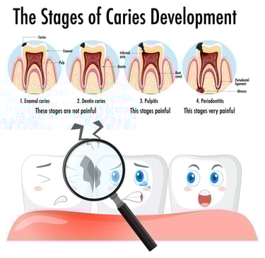 What is Tooth Decay?