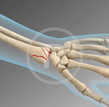 Wrist Fixation Medical Animation