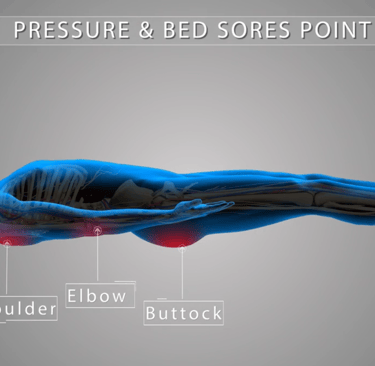 Pressure & Bed Sores Medical Animation