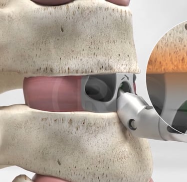 Screw Fixation On Spine Medical Animation