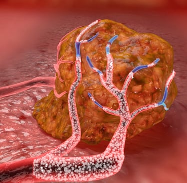 Tumor Medical Animation