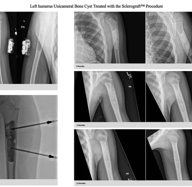 xray-unicameral-bone-cyst-humerus-sclerograft.jpg