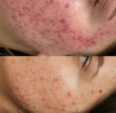 Visible acne improvement after structured skin transformation programme