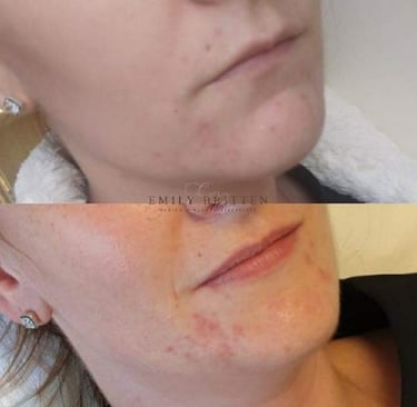 Reduction in acne and improved skin clarity following specialist treatment plan