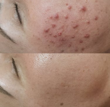 Acne before and after results demonstrating clearer skin and reduced breakouts