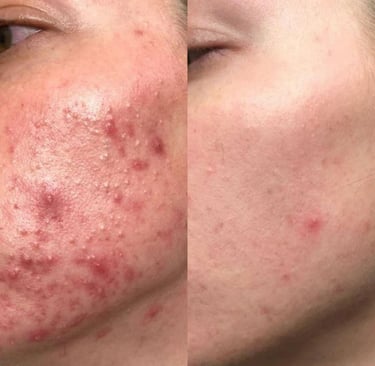 Client skin transformation after acne treatment with Emily Britten UK acne specialist
