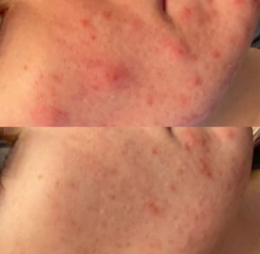 Clear skin results achieved through acne treatment journey with Emily Britten