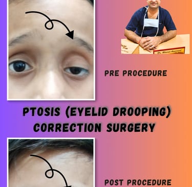 Before-and-after view of ptosis correction procedure to improve eyelid height in Udaipur by Dr Bharat agarwal.