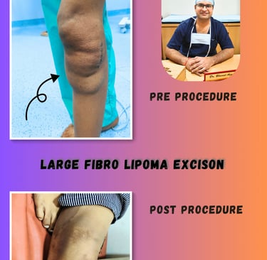 “Large lipoma excision by plastic surgeon Dr Bharat Agarwal in Udaipur with minimal scar results”