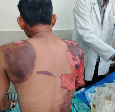 “Expert burn care in Udaipur provided by plastic surgeon Dr Bharat Agarwal”