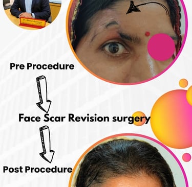 "Dr Bharat Agarwal performing scar revision surgery in Udaipur using microneedling technique"