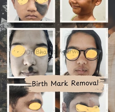 “Hairy black nevus birthmark on skin – evaluation and treatment options explained by Dr Bharat Agarwal”