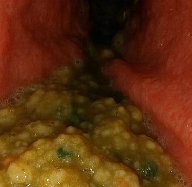  Vomiting and Obstructions in the Upper Gastrointestinal Tract 🔬  