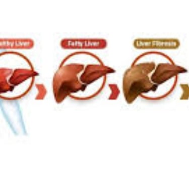 _Beware of the inevitable fate of fatty liver,fibrosis , cirrhosis, esophageal varices and hepatoma