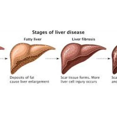 _Beware of the inevitable fate of fatty liver,fibrosis , cirrhosis, esophageal varices and hepatoma