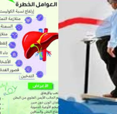 حالات مرض الكبد الدهني عوامل الخطر