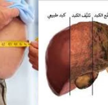 صورة مرض الكبد الدهني