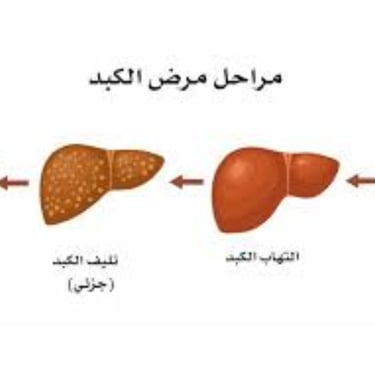 _احذروا المصير المحتوم للكبد الدهني وتشمع الكبد وتليف الكبد ودوالي المريء وسرطان الكبد (2)