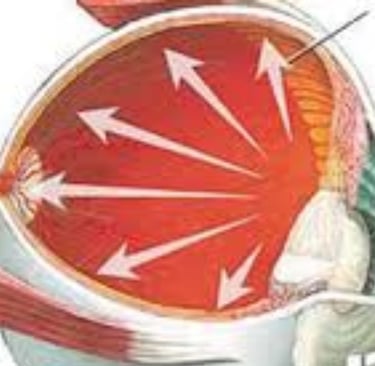 الجلوكوما : خيارات العلاج