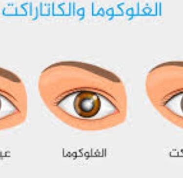 الجلوكوما : خيارات العلاج