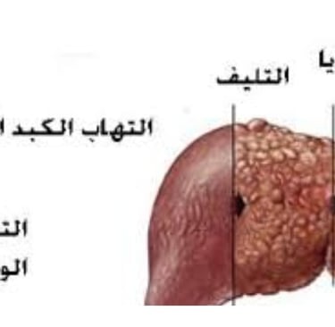 🛡️ اكتشف كيف يمكن أن يدعم الصيام التطوعي والعسل صحة الكبد لدى مرضى فيروس التهاب الكبد الوبائي ج (HC