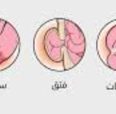 القيء من انسدادات الجهاز الهضمي العلوي
