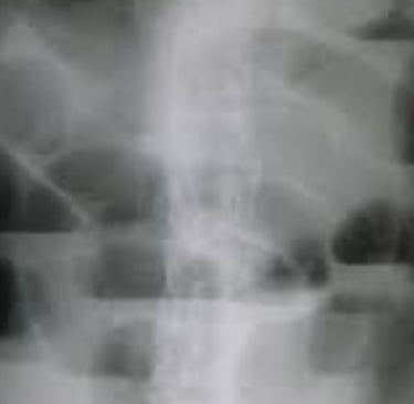 القيء من انسدادات الجهاز الهضمي العلوي