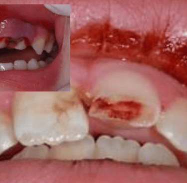 gum disease