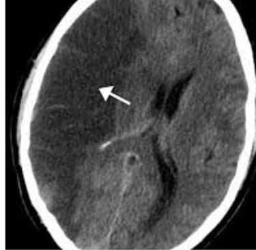 A stroke may damage the tissue that produces obstruction CSF or block the flow of CSF