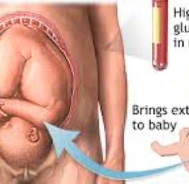 gestational diabetes